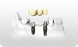 Fixed-Bridge using Dental Implants.